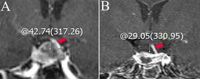 Novel Nomograms to Predict Delayed Hyponatremia After Transsphenoidal Surgery for Pituitary Adenoma